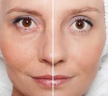 What is mesotherapy treatment 640x600 1