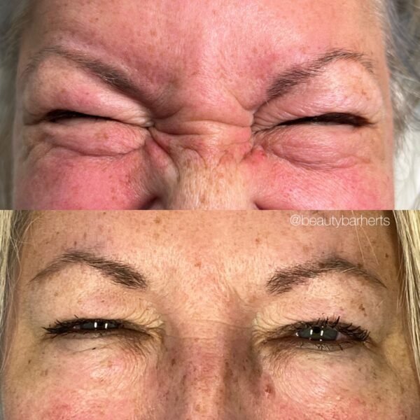 anti wrinkle botox hertfordshire