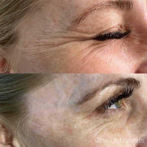 anti wrinkle treatment hertfordshire