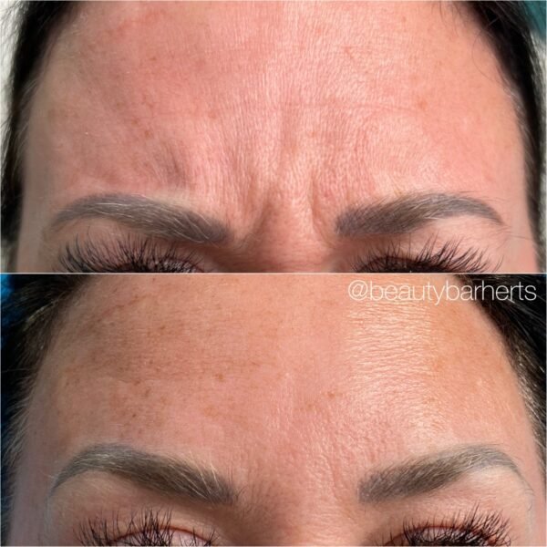 botox anti wrinkle hertfordshire