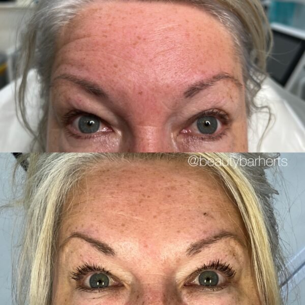botox eyebrow lift hertfordshire