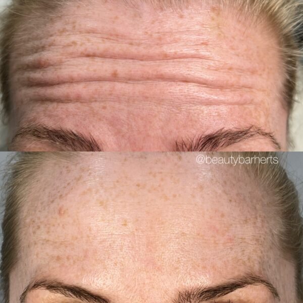 botox for forehead hertfordshire