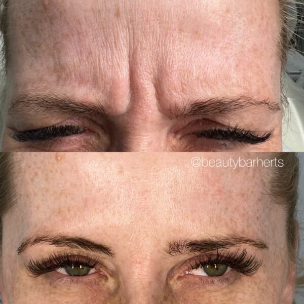 botox in ware