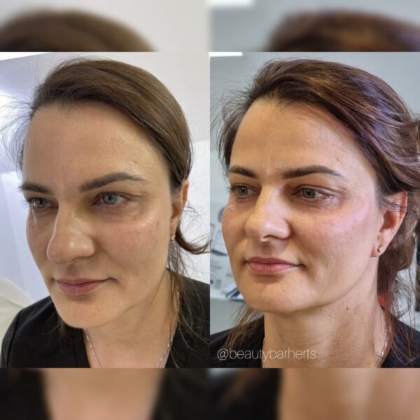 cheek filler beauty bar herts