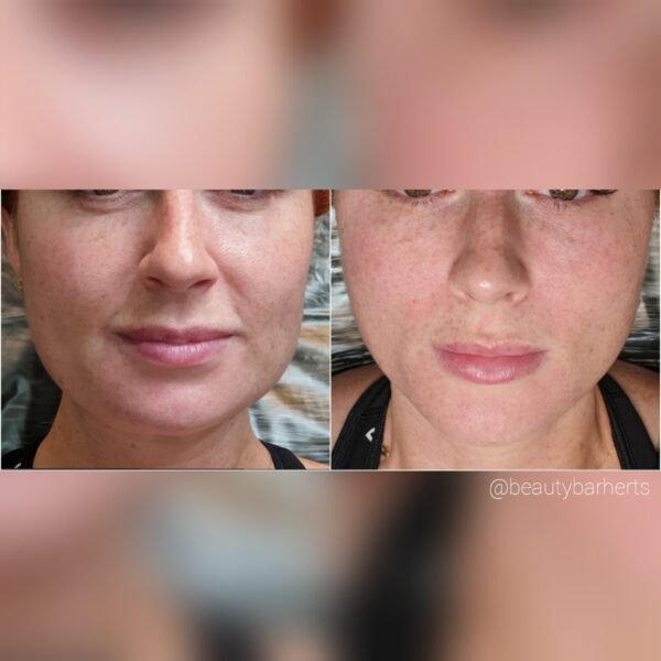 chemical peel before after