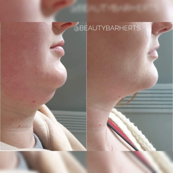 double chin treatment fat dissolve