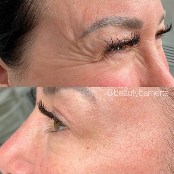 eye wrinkle treatment hertfordshire