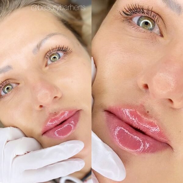 fuller lips treatment