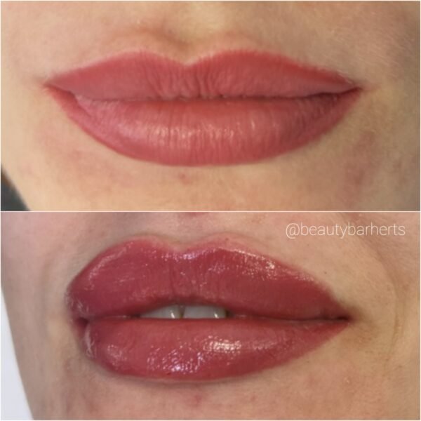 lip filler beauty bar