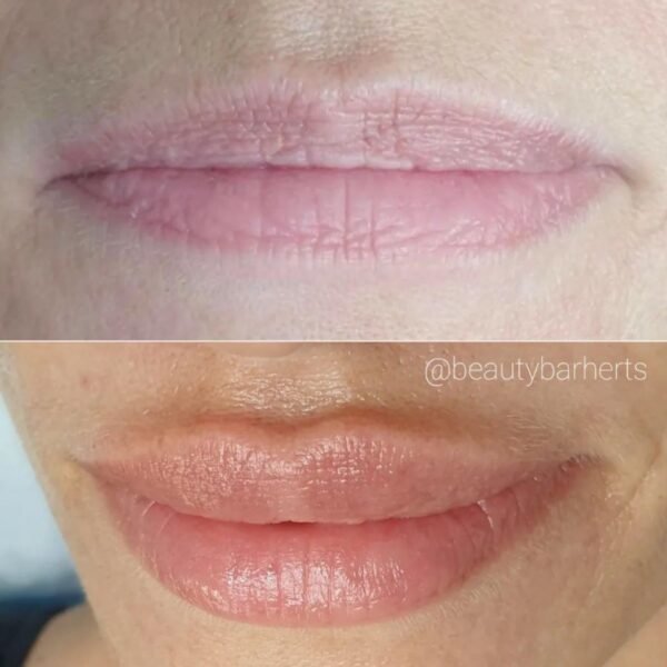 lip filler before after