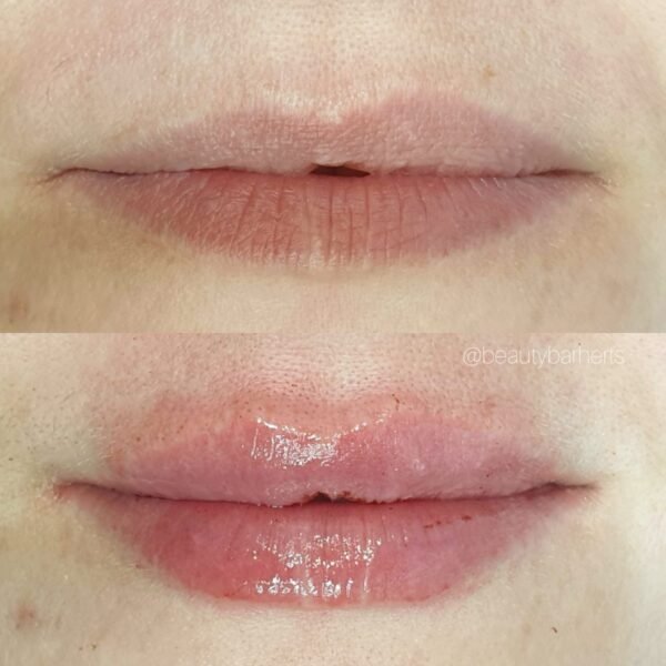 lip filler symmetrical lips