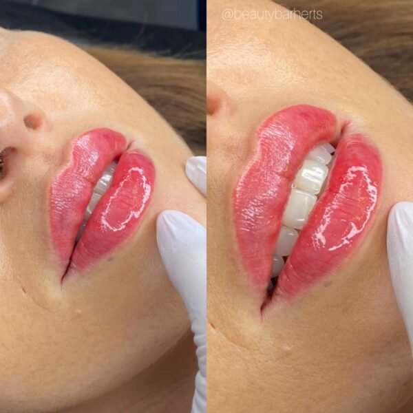 natural lip filler hertfordshire