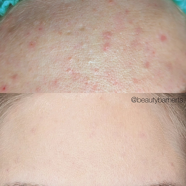 acne treatment before after hertfordshire