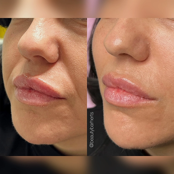 best cheek filler treatment best cheek filler treatment