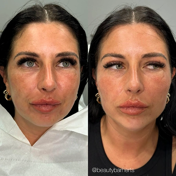 dermal filler ware dermal filler ware