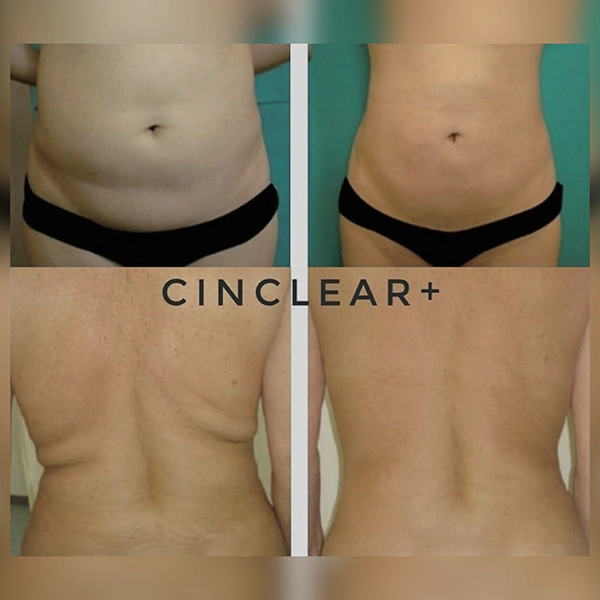 fat dissolving treatments sawbridgeworth