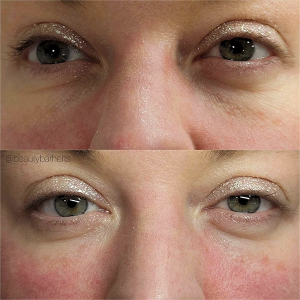 tear trough filler hertfordshire