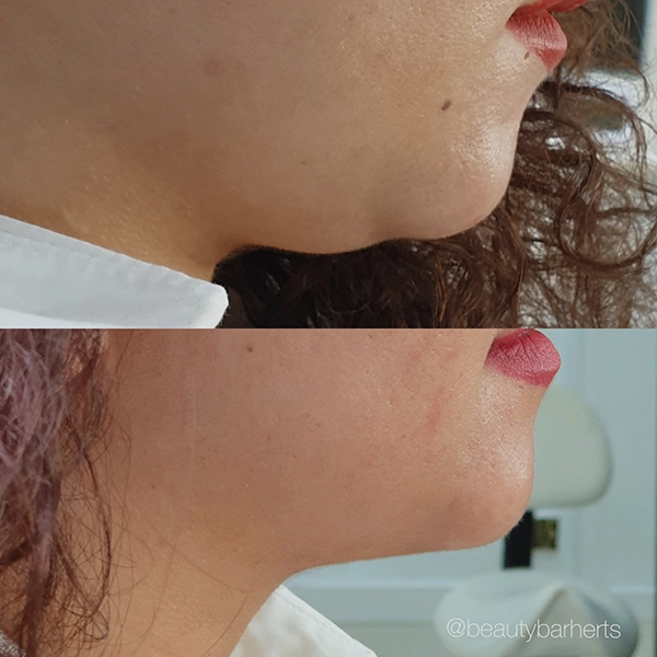 weight loss treatments cuffley