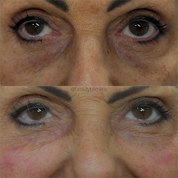 best tear trough filler hertfordshire