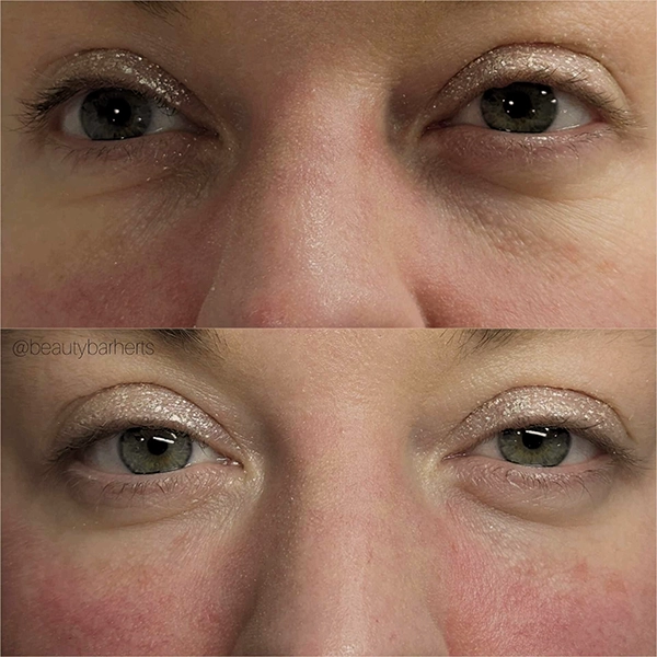 natural tear trough filler hertfordshire