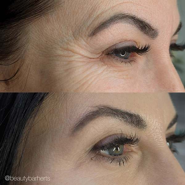 anti wrinkle bengeo