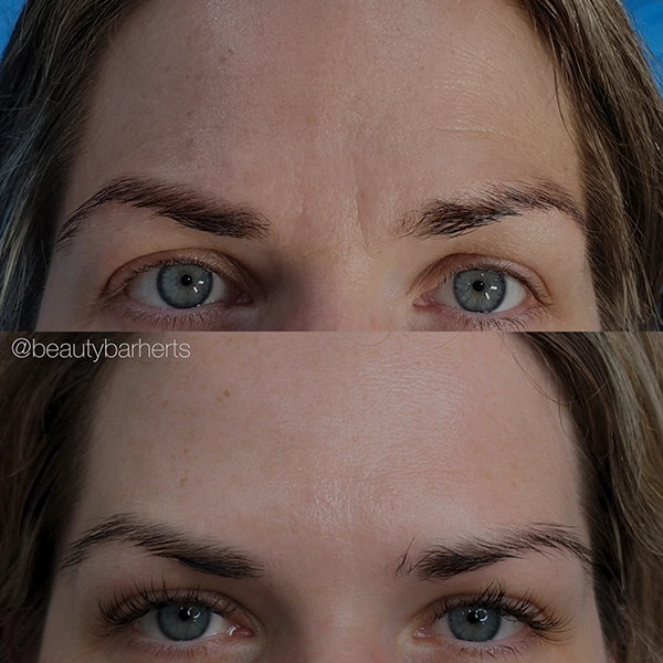 anti wrinkle broxbourne
