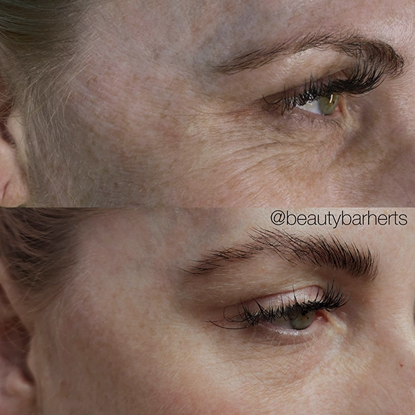 anti wrinkle hertford