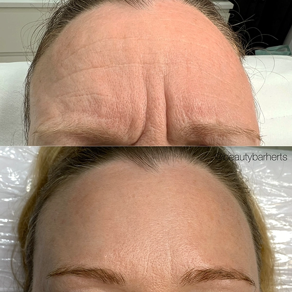 anti wrinkle hertfordshire