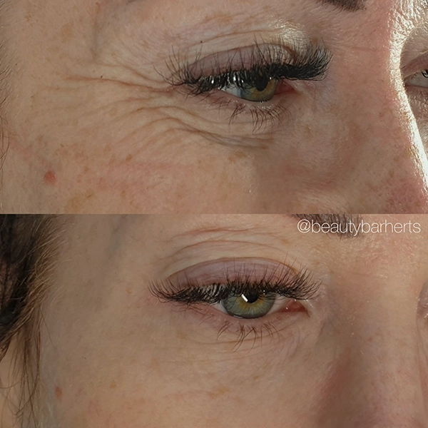 anti wrinkle hoddesdon
