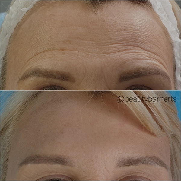 anti wrinkle royston