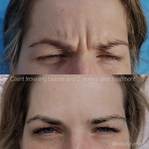 anti wrinkle treatment cheshunt