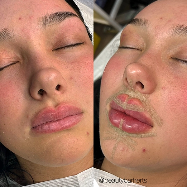 best lip filler correction hertfordshire