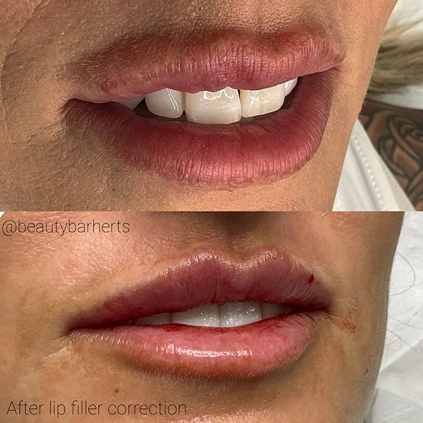 best lip filler correction ware