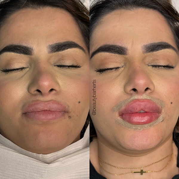 butterfly lip filler specialist hertfordshire