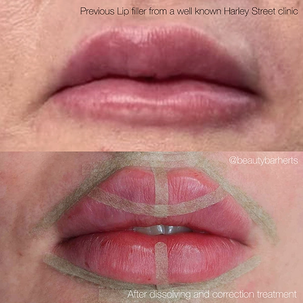 corrective lip filler treatment hertfordshire