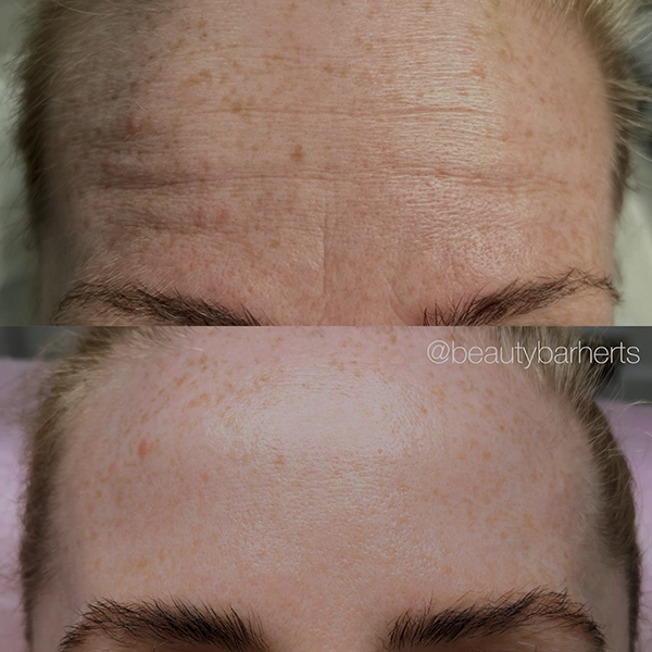 hertfordshire anti wrinkle clinic