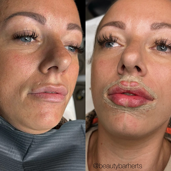 lip filler correction clinic hertfordshire