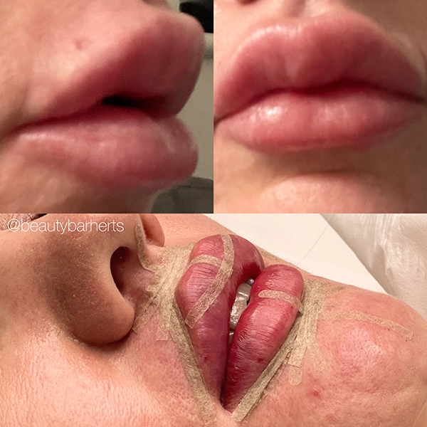 lip filler correction in hertfordshire