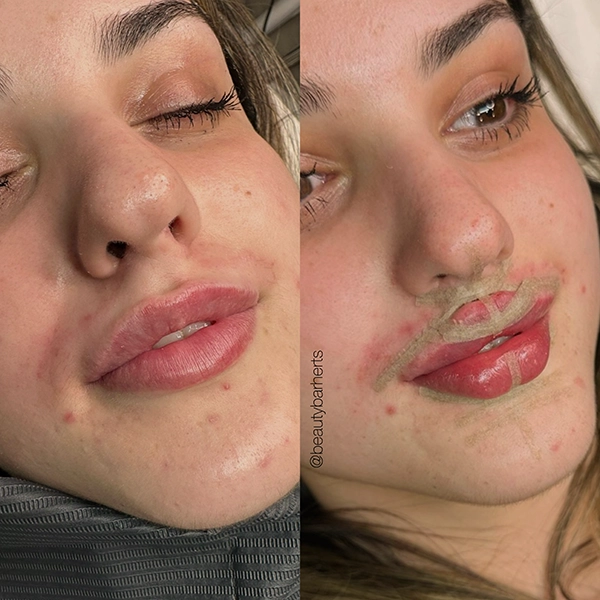 lip filler correction specialist hertfordshire
