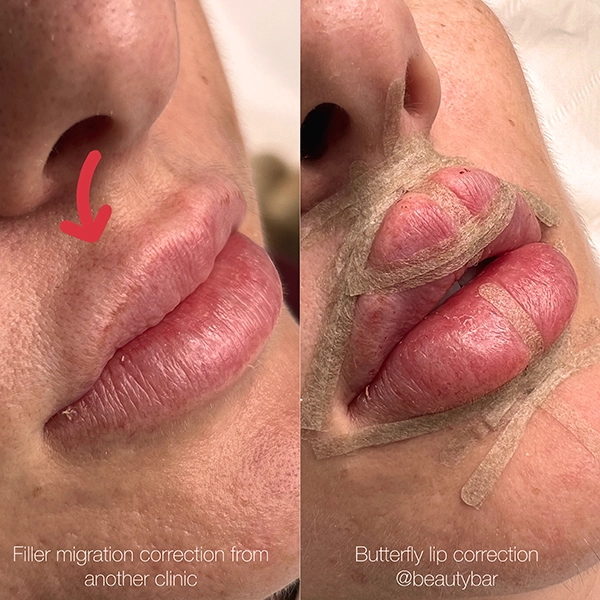 lip filler migration correction hertfordshire
