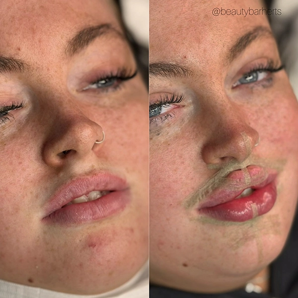 natural lip filler correction ware
