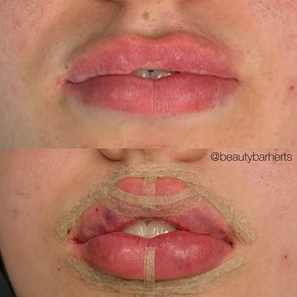 strip lips hertfordshire