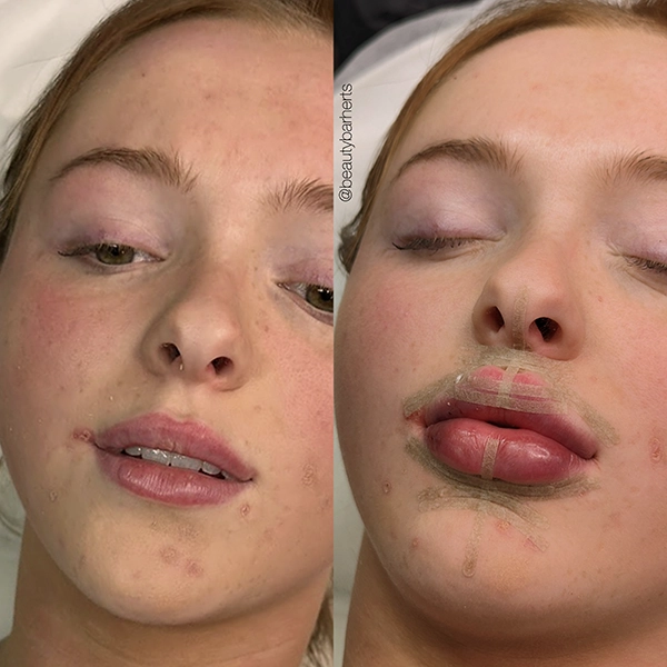 strip lips specialist hertfordshire ware