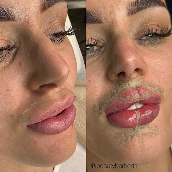 tape lips hertfordshire