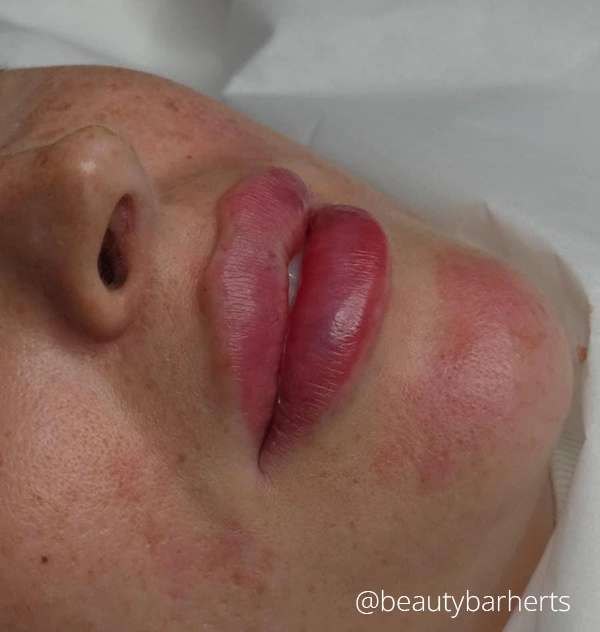 Lip filler concerns hertfordshire