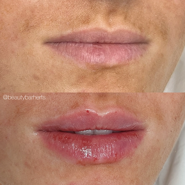 avoid before lip filler hertfordshire