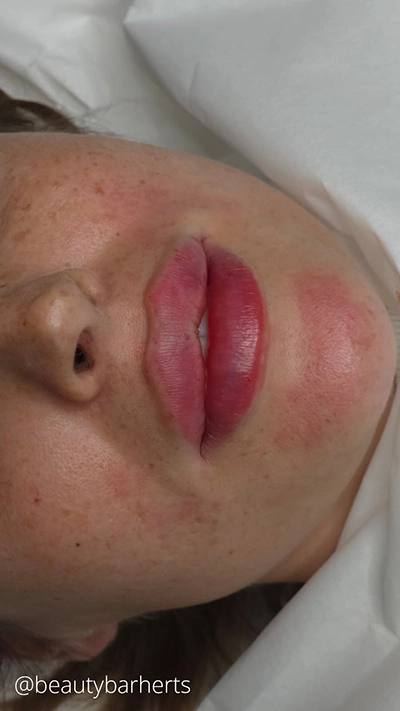 lip filler concerns buntingford