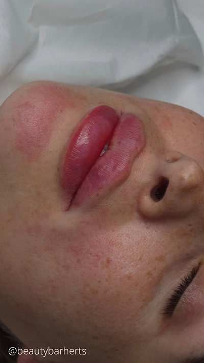 lip filler concerns hertford