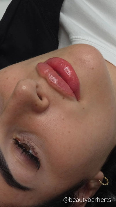 lip filler concerns ware