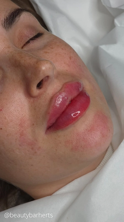 lip filler concerns welwyn garden city